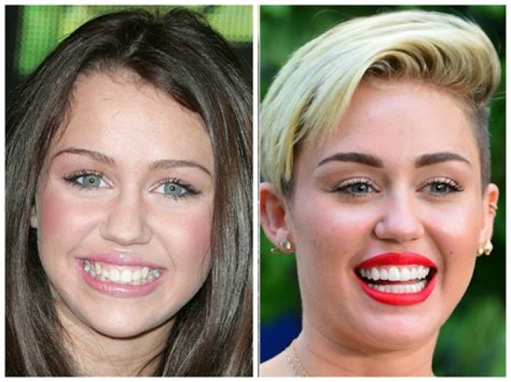 20 Celebrities with Veneers Just Like Us Regular People