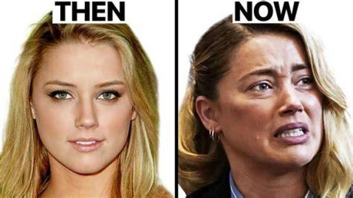 Amber Heard Plastic Surgery Analysis Before and After Transformation