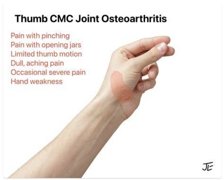 Arthritis of the Thumb Symptoms & Treatment Singapore Sports and