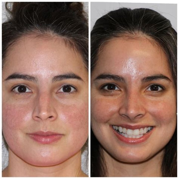 Beforeandafter photos of scarless rhinoplasty patient Rhinoplasty