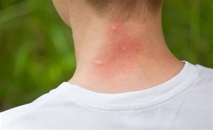 Best Oak Mite Bites Vs Bed Bug Bites Pest Phobia