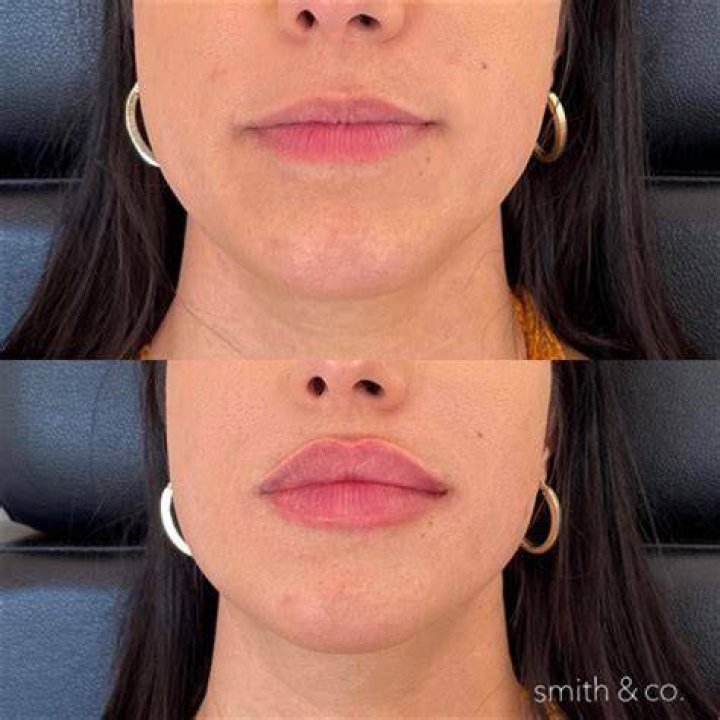 Beth Dutton Lip Injections Surgery Before And After Photos