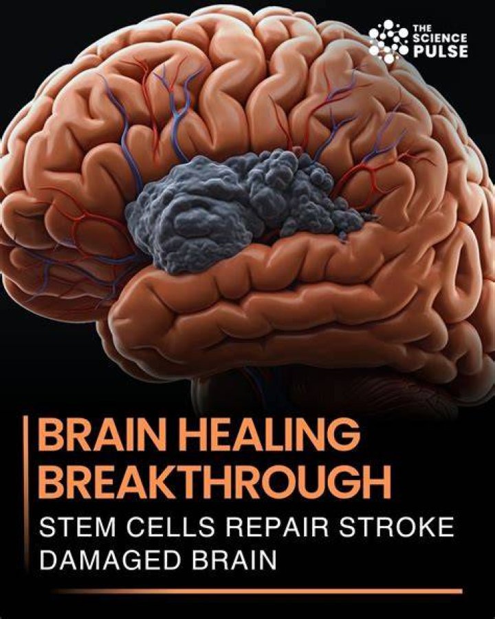 Can brain repair itself after stroke?