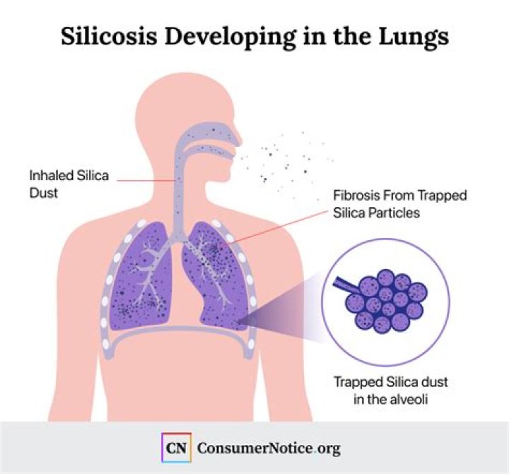 Can silica cause lupus?