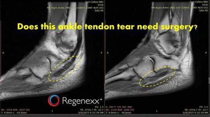 Can You Self-Heal A Torn Tendon?