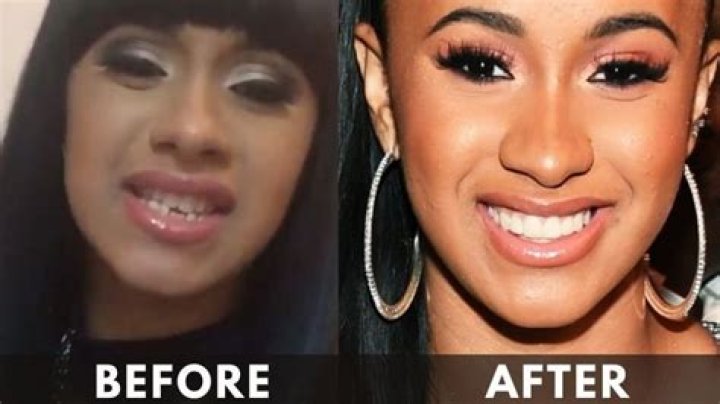 Cardi B Teeth Transformation Surgery, Cost, Before and After