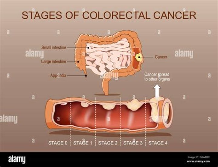 Colon & Rectal Cancer (Colorectal Cancer) Treatment Alaska Surgical