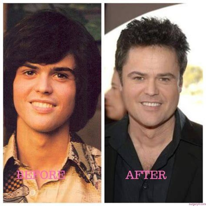 Did Donny Osmond Have Plastic Surgery? Everything You Need To Know