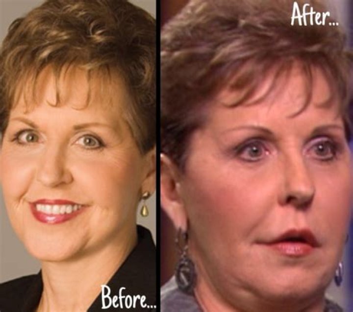 Did Joyce Meyer have Plastic Surgery? Joyce Meyer Before and After News