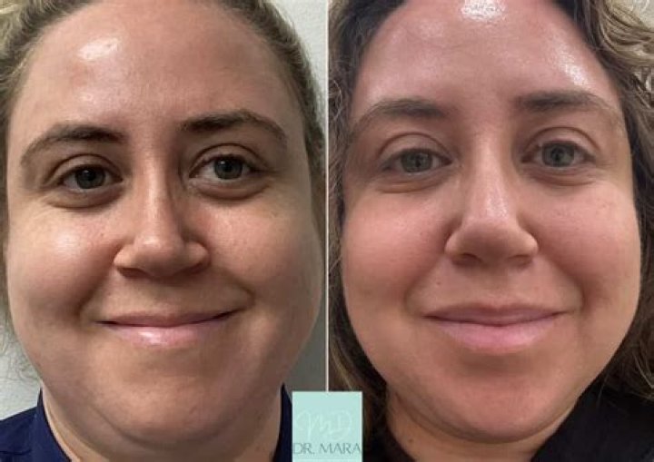 Discover The Transformative Power Of Jelly Roll Botox: Before And After Unveiled