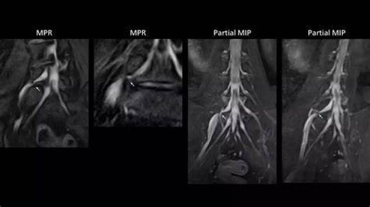 Do inflamed nerves show up on MRI?