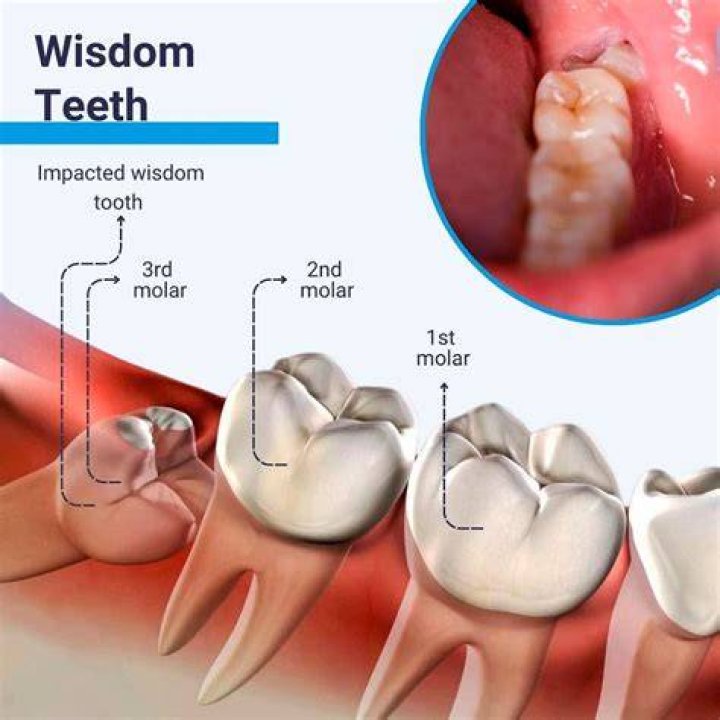 Do models remove their wisdom teeth?