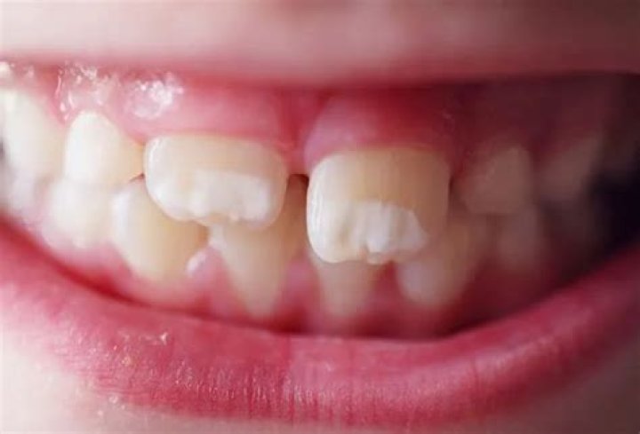 Do white spots on teeth go away?