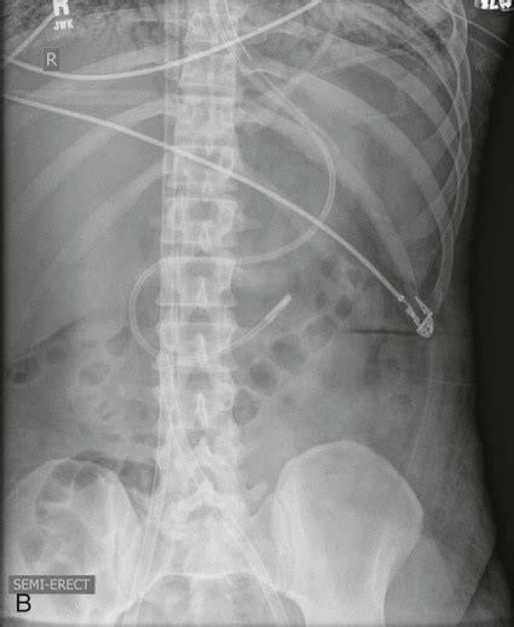 Dobhoff Tube Placement X Ray 2 The tube continuing straight below