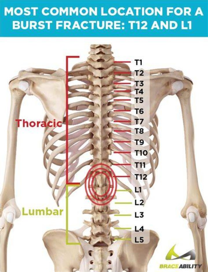 Does A Broken T12 Worsen With Time?