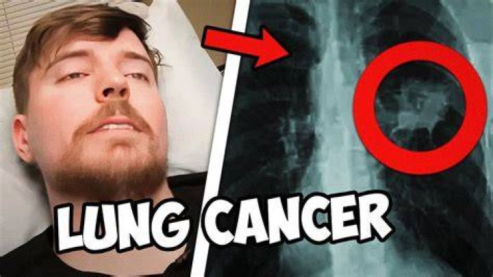 Does MrBeast have lung cancer? The Hiu