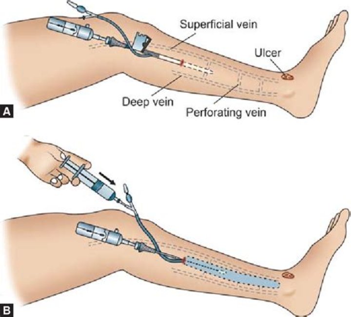 How do you treat an incompetent perforator?
