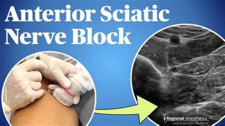 How is a sciatic nerve block performed?