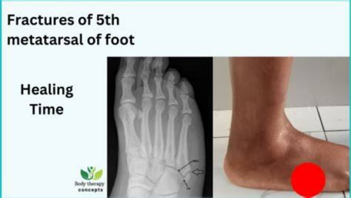 How long does it take for a nondisplaced metatarsal fracture to heal?