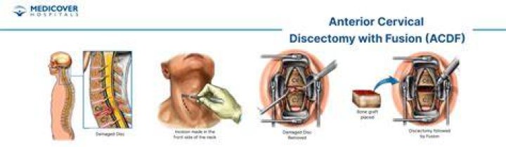 How serious is neck fusion surgery?