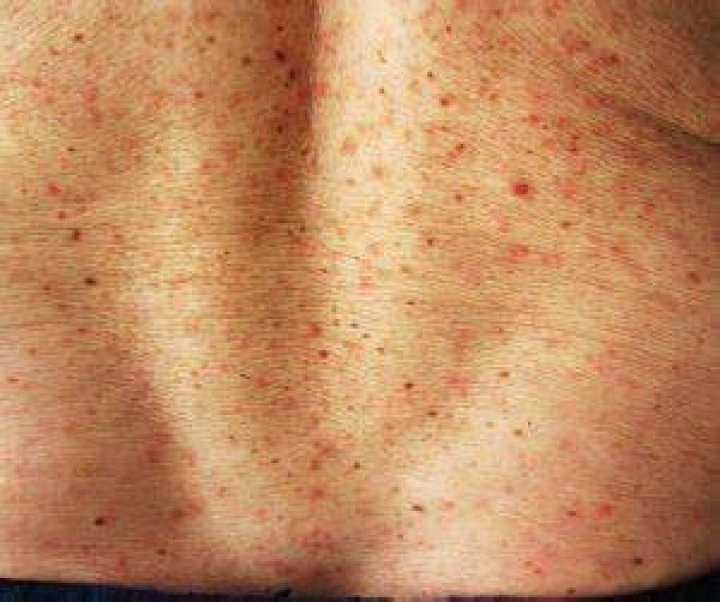 INDOOR ENTOMODERMATOSES TYPICAL LESIONS Perprin S.r.l. All rights