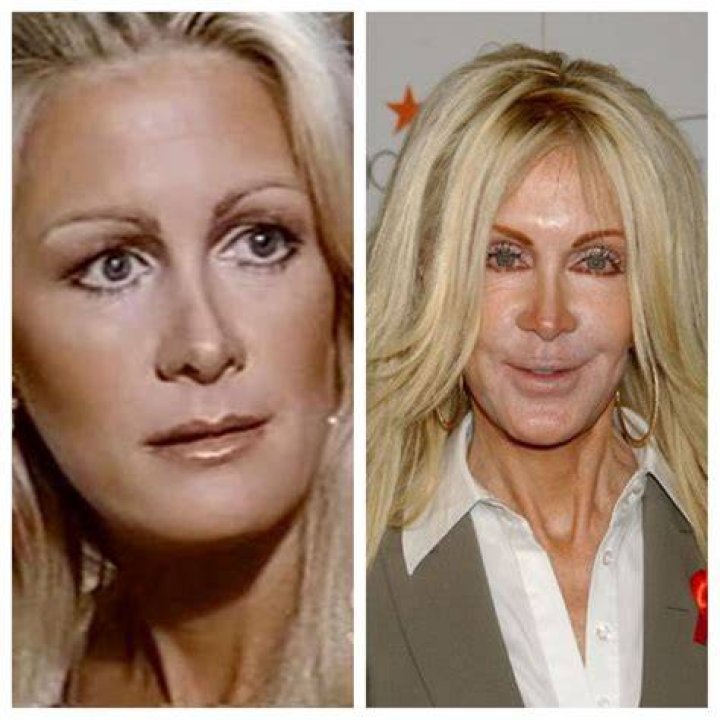 Joan Van Ark Plastic Surgery Before and After Rhinoplasty and Cheek