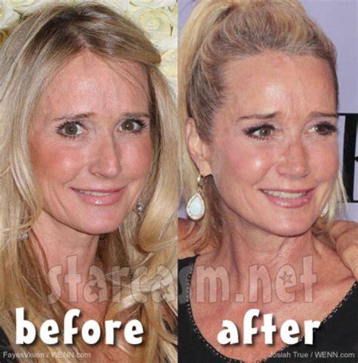 Kim Richards plastic surgery (13) Celebrity plastic surgery online