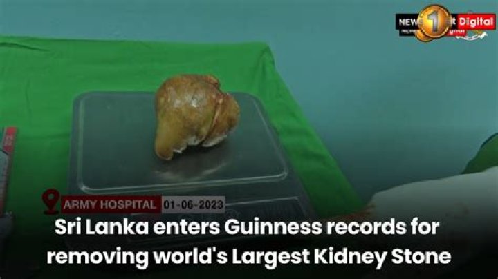 Largest kidney stones enters Guinness World Records |