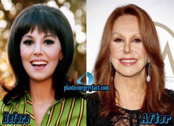 Marlo Thomas Plastic Surgery Diversity News Magazine Marlo thomas
