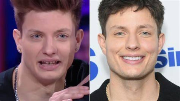 Matt Rife Before Veneers: Unveil The Transformation