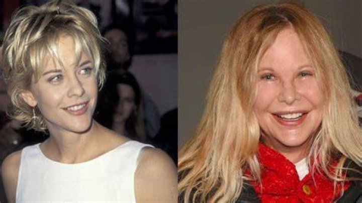 Meg Ryan's Transformation: Plastic Surgery Revelations