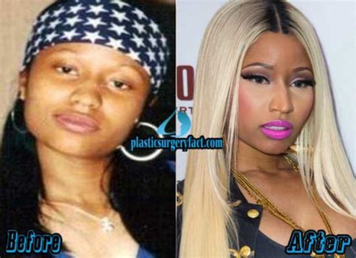 Nicki Minaj Before And After Skin Bleaching