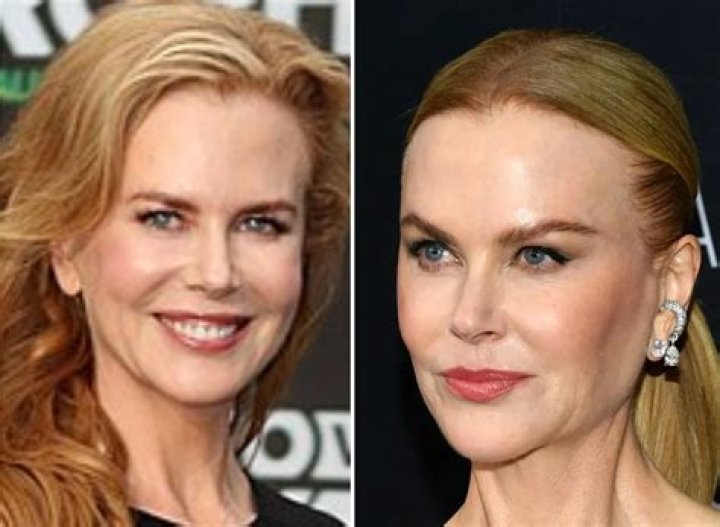 Nicole Kidman’s Plastic Surgery Transformation Top Docs Claim