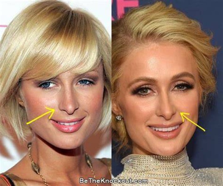 Paris Hilton Plastic Surgery Before and After Pictures 2024
