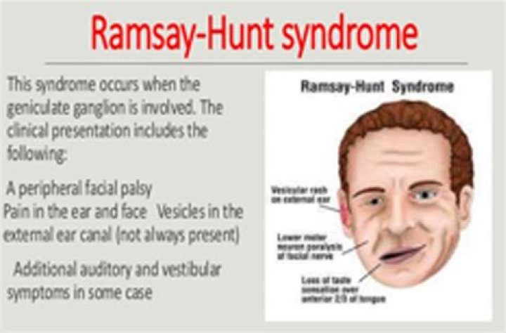 Ramsay Hunt Syndrome