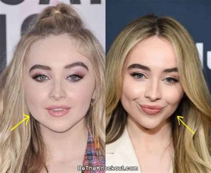 Sabrina Carpenter Plastic Surgery Botox And Lip Filler