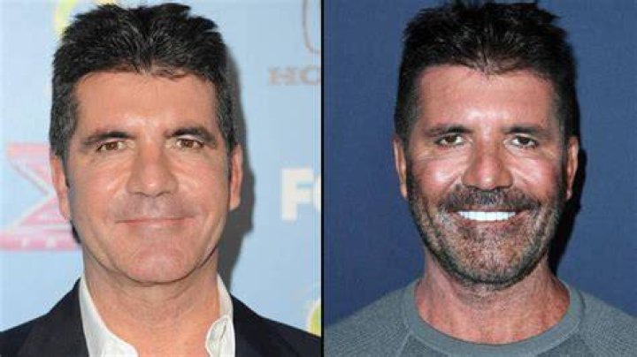 Simon Cowell undergoes surgery after breaking back while at home with