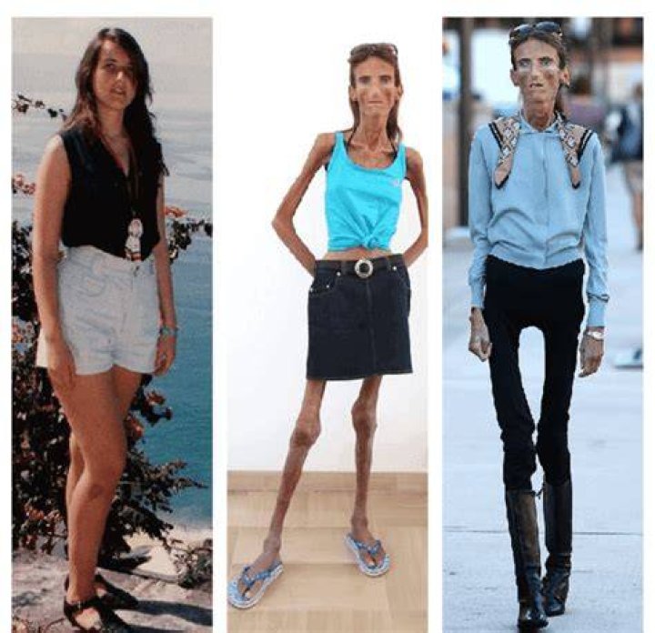 The skinniest Person Ever World Skinniest People You should Know
