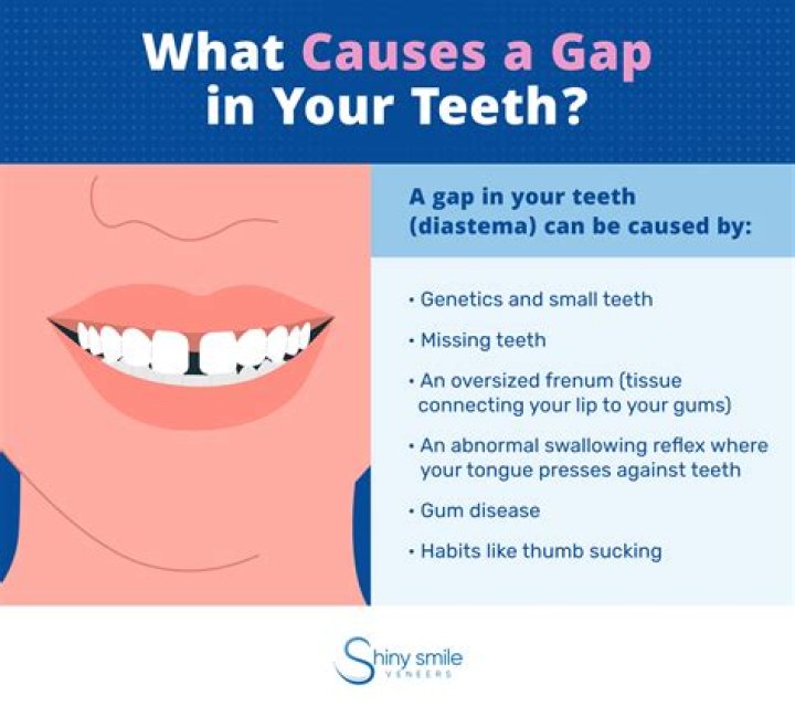 Tooth Gap Where does the gap between the teeth come from?