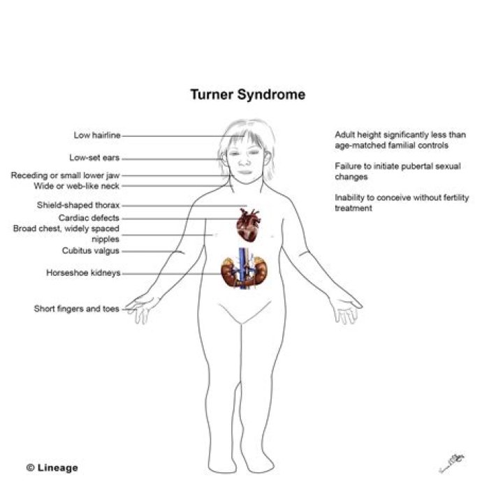 Turner Syndrome Through Inspiring Faces