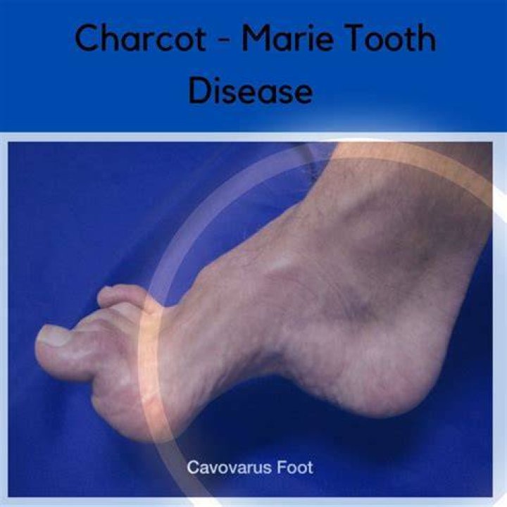 Uncovering The Impact Of Charcot-Marie-Tooth