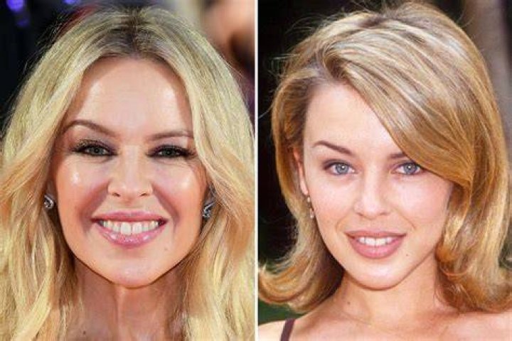 Uncovering The Truth Behind Kylie Minogue's Plastic Surgery Rumors