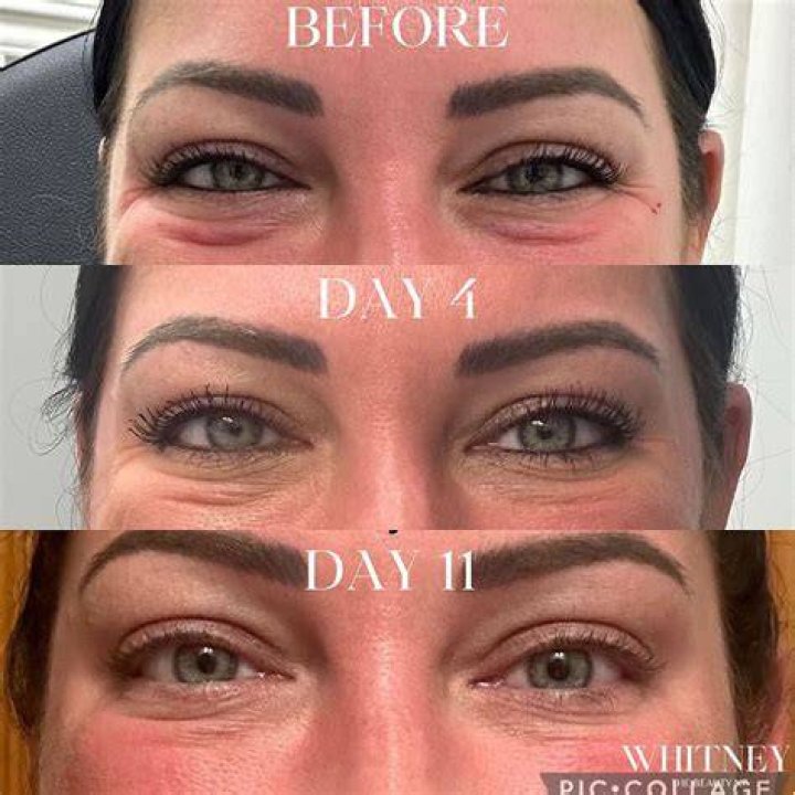 Unlock The Secrets Of Jelly Rolls Under Eyes: Discoveries And Insights Revealed