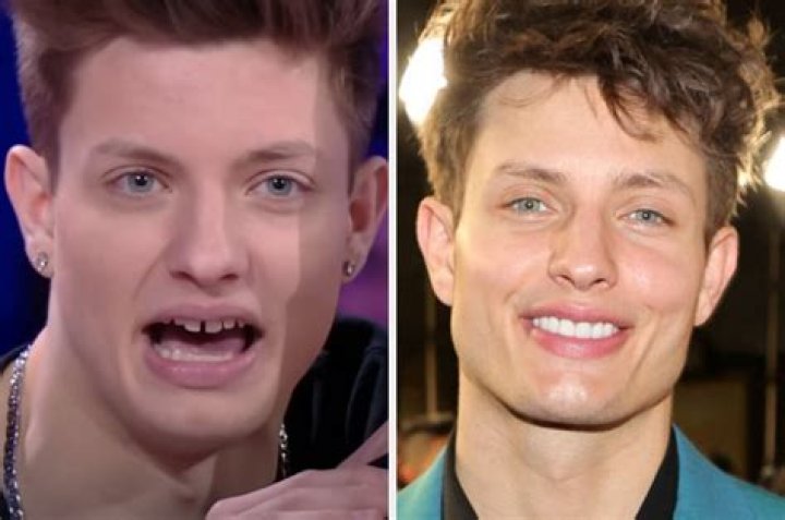 Unveiling The Evolution: Matt Rife's Smile Transformation