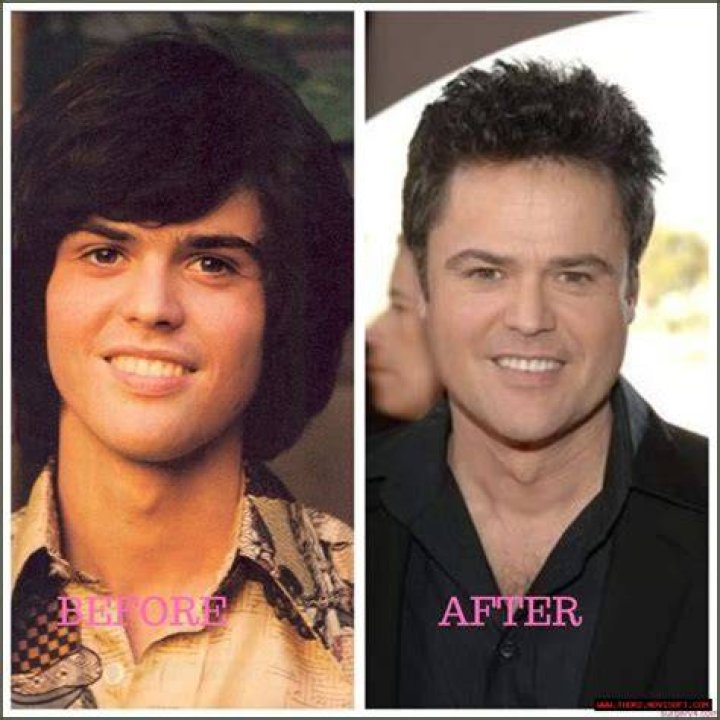 Unveiling The Secrets Of Donny Osmond's Plastic Surgery Journey