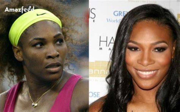 Unveiling The Surprising Truths Behind Serena Williams' Facial Surgery