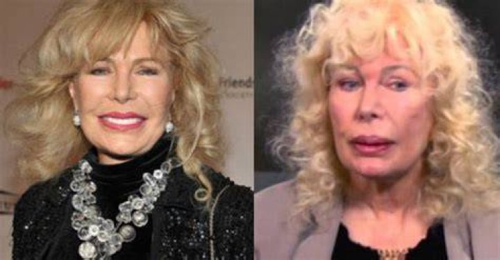 Unveiling The Truth Behind Loretta Swit's Plastic Surgery Journey