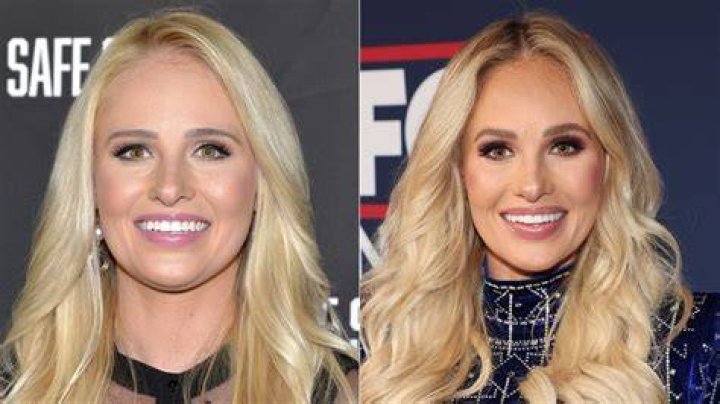 Unveiling Tomi Lahren's Nose Job: Discoveries And Insights