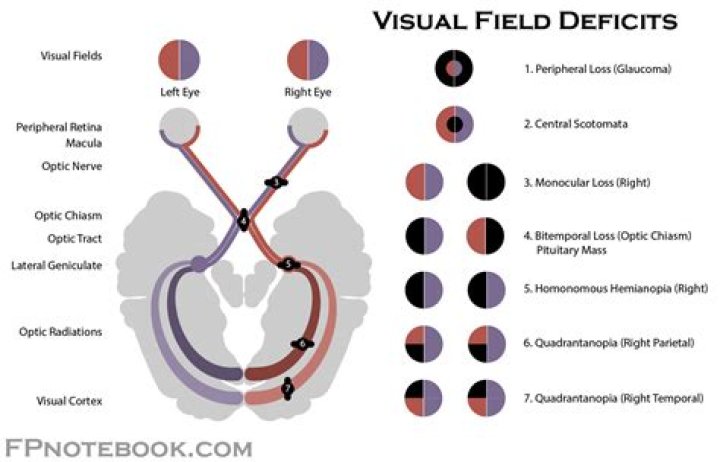 What causes loss of field of vision?