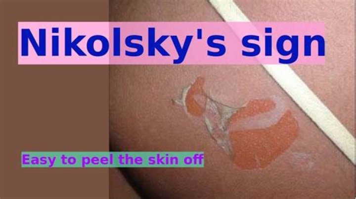 What does Nikolsky sign indicate?